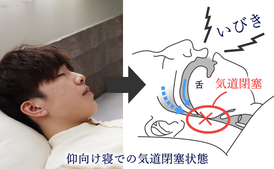 睡眠時の閉塞状態